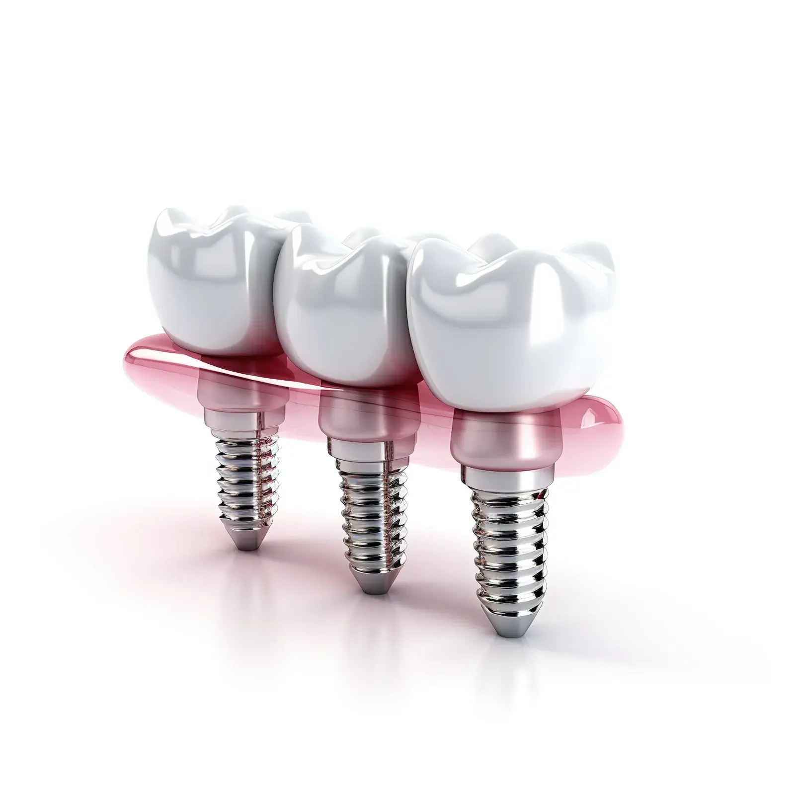 Dental implant model next to a crown and bridge restoration in Calgary