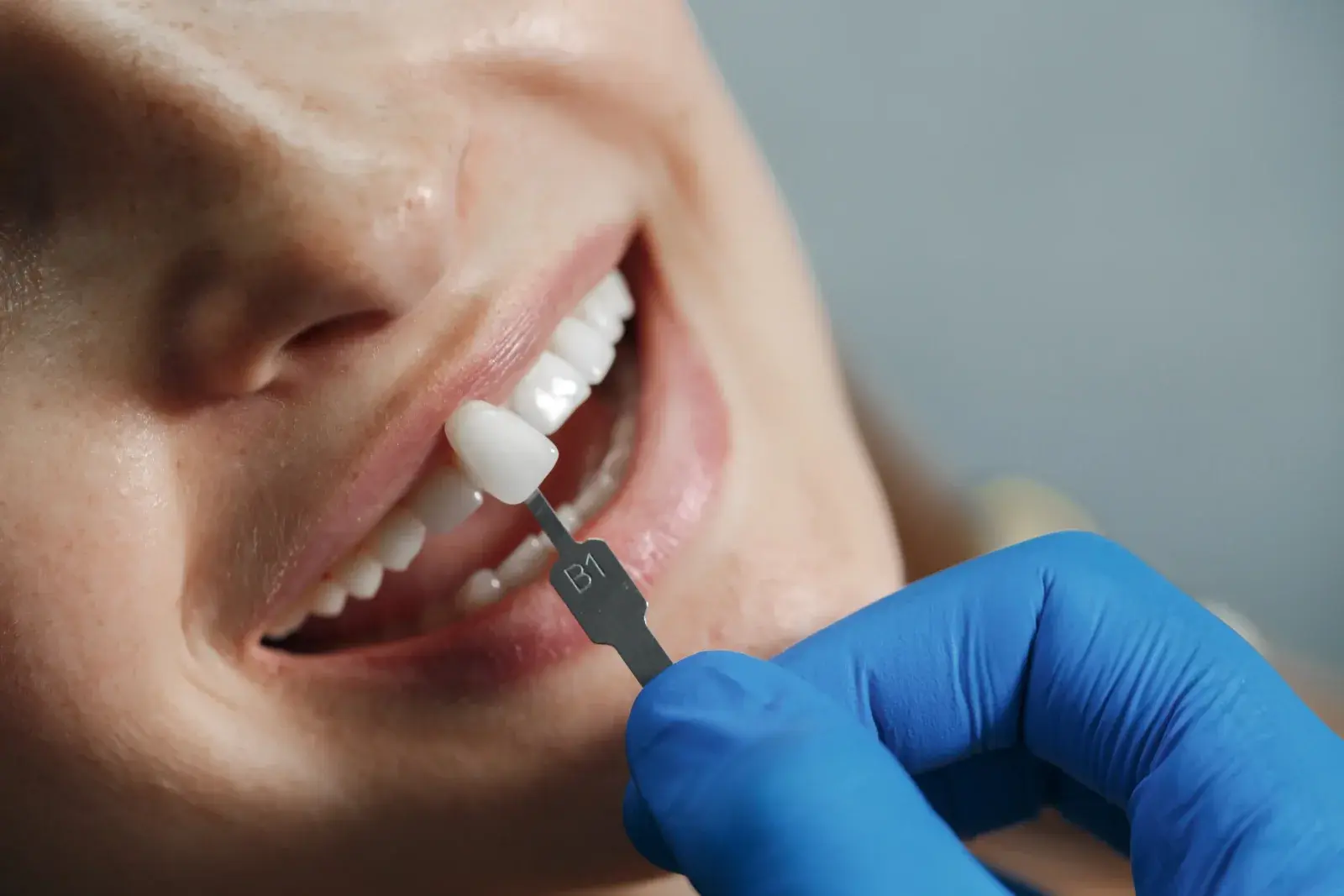 Close up of porcelain veneers being fitted at a Calgary dental clinic